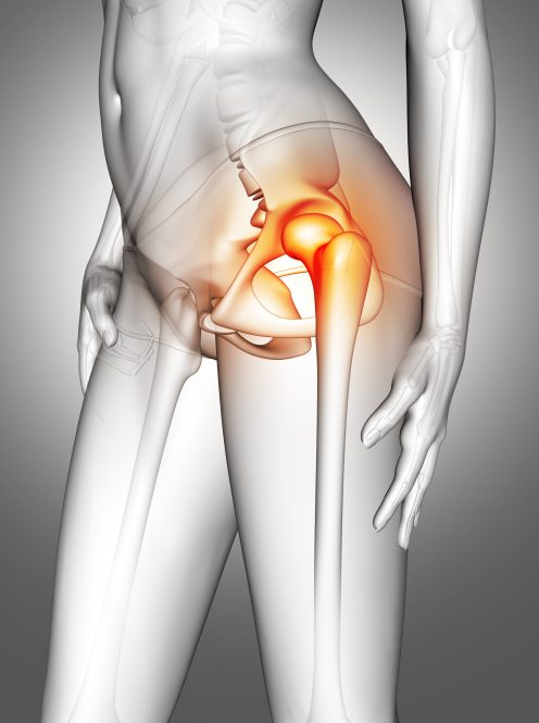 3D render of a female medical figure with hip bone highlighted
