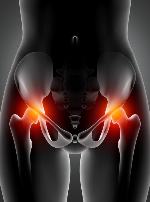 3D render of a female medical figure with hip bones highlighted