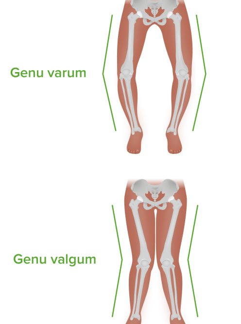 Genu-varum-and-valgum